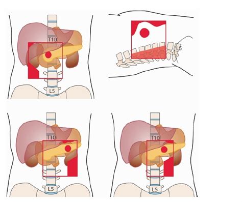 췌장암 3기를 극복 친구이야기 2부 수술후 표준항암치료를 거부하고 건강을 회복한 이야기 입니다. 췌장암 Pancreatic Cancer : 암이란닷컴
