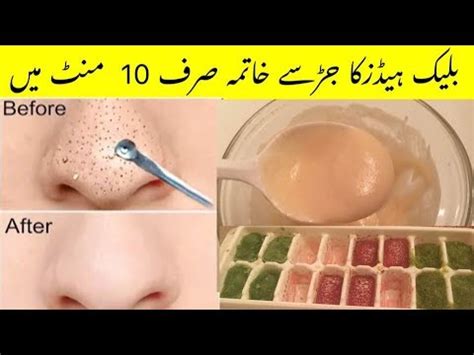 We know blackheads annoy you. How to Remove Blackheads & whiteheads Home Remedy in Urdu ...