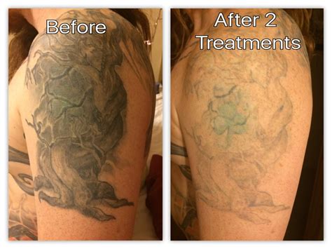 Check spelling or type a new query. Before & After — Disappearing Ink Laser Tattoo Removal