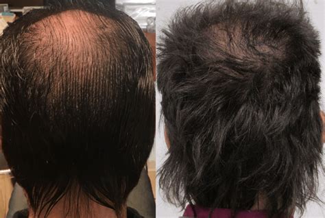 Ruuts team in ruuts hair growth solutions. Real hair growth client success stories and reviews