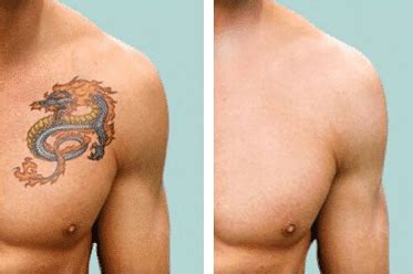 And there is a slight chance that you will have a permanent scar. How Laser Effective Tattoo Is Removal