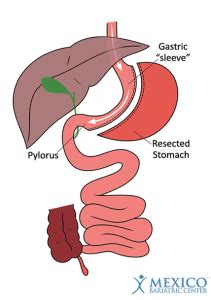 Maybe you would like to learn more about one of these? Gastric Sleeve Surgery - Obesity Reporter