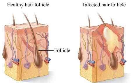 Here are pictures, removal, treatment for infected cysts and how to eliminate ingrown hair roots cysts naturally. Treating and Preventing Painful Ingrown Pubic Hairs | Med ...