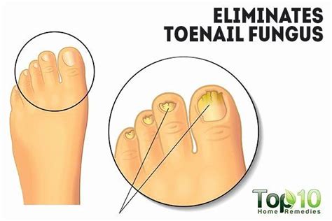 Hydrogen peroxide with vinegar 7. Hydrogen Peroxide for Nail Fungus Fresh top 10 Amazing ...