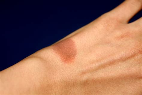 Learn to distinguish them, see brown spots pictures. Burn on the hand. Brown spot on skin after burn - Idrilog