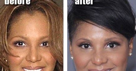 Braxton has admitted that she had rhinoplasty in 1993. Toni Braxton Plastic Surgery Before and After Nose Job and ...