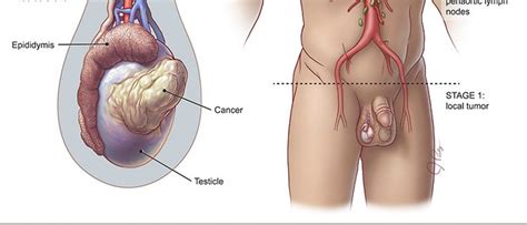 What testicular cancer, excessive radiation, and divorce can do to a man. TESTICULAR CANCER & Cannabis studies completed