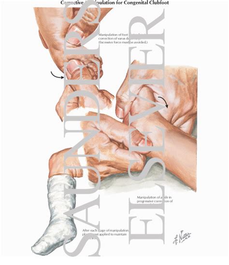 Try dragging an image to the search box. Corrective Manipulation for Congenital Clubfoot