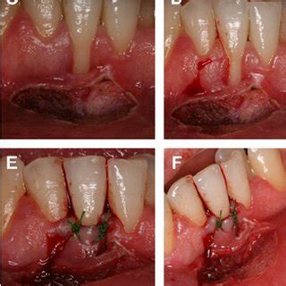 Council conclusions are adopted after a debate during a council meeting. (PDF) Laser-Assisted Laterally Positioned Flap Operation ...