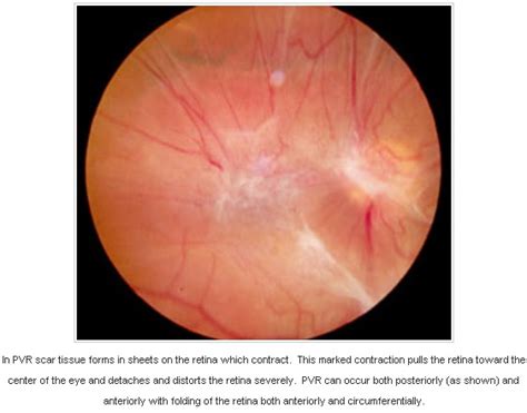 Scar tissue · 11th jul 2015 · 1,806 words. Doctors Gates: PVR or Proliferative Vitreo-Retinopathy ...