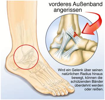Ein außenbandriss äußert sich durch sehr starke und intensive schmerzen. Bänderriss am Fuß: Anzeichen, Symptome, Ursachen ...