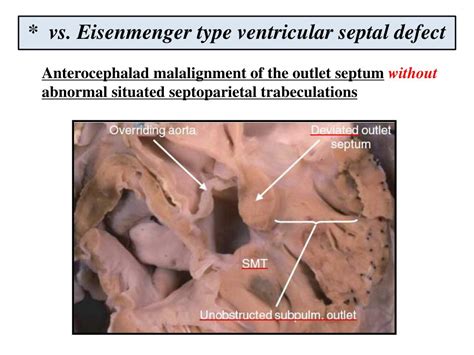 Tetralogy of fallot (tof) is the most common cyanotic congenital heart condition with many cases presenting after the newborn period. PPT - Anatomy and pathophysiology of tetralogy of Fallot ...