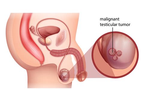 Testicular cancer is a disease that occurs when cancerous (malignant) cells develop in the tissues of a testicle. Testicular Cancer: Signs, Symptoms and Treatment options ...