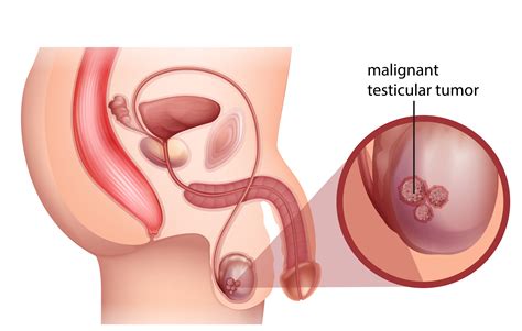 Testicular cancer is highly treatable especially if caught early. Testicular Cancer: Signs, Symptoms and Treatment options ...