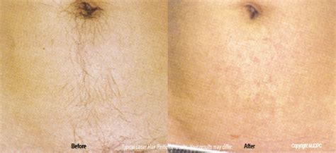 What's the best hair removal cream for the face? EpiLaser Hair Removal, TopDocs.com