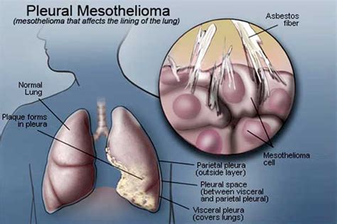 Most diagnosed cases are pleural mesothelioma, which forms on the lining of the lungs. Facts About Mesothelioma Cancer | Factual Facts