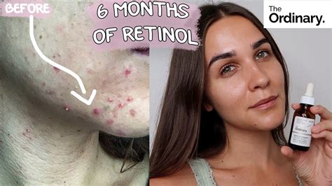 Check spelling or type a new query. RETINOL CLEARED MY ACNE / BEFORE & AFTER | 6 months update ...