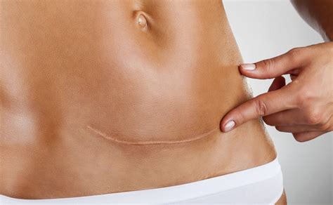 Unnecessary cesarean sections leave scars and may result in longer healing times, trauma, and bigger medical bills for new mothers. 12 Breathtaking C-section scar tattoos - SheKnows