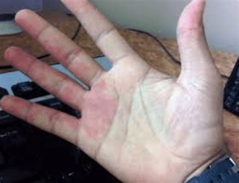 Selamat siang mi,telapak tangan yang tampak merah, bengkak, sakit dan terasa hangat adalah tanda adanya peradangan pada area tersebut. Cara Deteksi Penyakit dengan Mudah Menggunakan Telapak ...