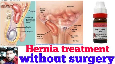 However, some websites today make claims that mesh is unsafe, and that repairing hernias without mesh is better. Hernia! Homeopathy treatment without surgery? Hernia top ...