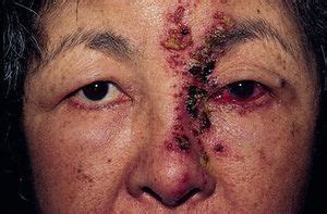 What Is Shingles (Herpes Zoster)? - American Academy of Ophthalmology