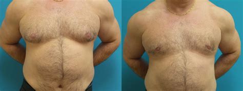 Left untreated, male breast enlargement can cause a complex surrounding body image. Male Breast Reduction & Gynecomastia Before and After Case ...