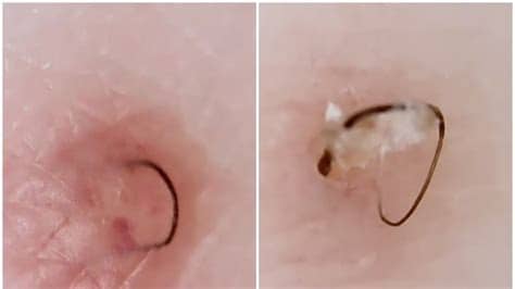 Plucking your armpit hair is not really bad at all but plucking the hair will hurt your skin in the long run. Ingrown Hair Removal Account | Teen Vogue