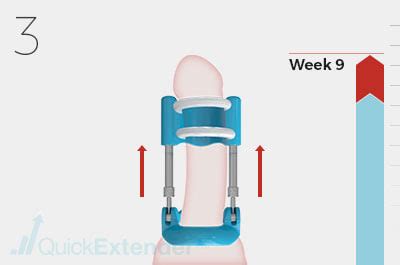 Jun 05, 2021 · how do you use a quick extender pro? Peyronies Disease, Peyronie's Disease Treatment