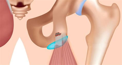 Pelvic Avulsion Fracture - Symptoms, Causes and Treatment