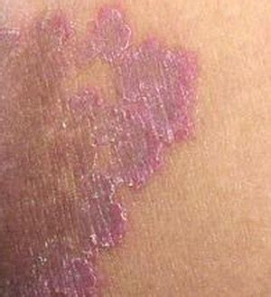 As well as problems with the female reproductive system. Fungal Rash - Symptoms, Causes (Risk Factors), Pictures ...