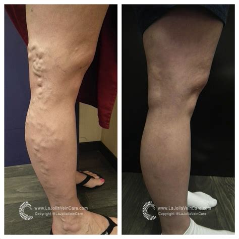 Milia are white to yellowish, hard, raised cysts that develop under the outermost layer of skin. How Long Does it Take for Varicose Veins to Go Away? - La ...