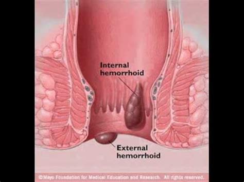 Unter thrombose versteht man einen gefäßverschluss durch ein blutgerinnsel. Constipation Hemorrhoids - Thrombosed Piles - Natural ...