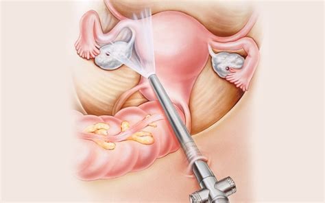 Learn about endometriosis, including possible treatments for this condition that causes pain and endometriosis occurs when bits of the tissue that lines the uterus (endometrium) grow on other. Endometrioza a niepłodność « maluchy.pl