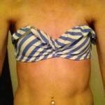 Maybe you would like to learn more about one of these? Female breast development photos » Breast Augmentation ...