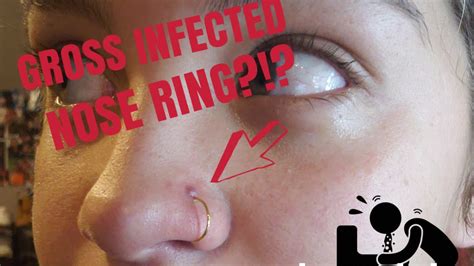 What you need to know. Quick & easy way to cure an infected nose ring. - YouTube