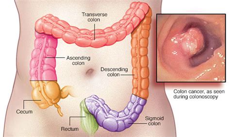 Colorectal / colon cancer is the 2nd most common cancer in malaysia and top cancer in singapore. Colorectal cancer second leading cancer in Malaysia ...