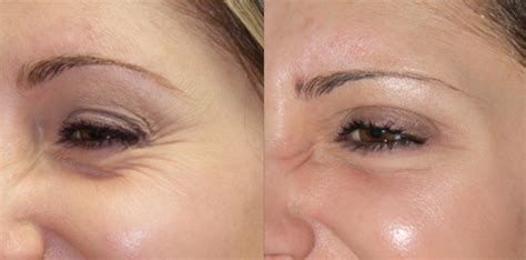 Wrinkles or fine lines under the eye can make your skin look aged and dreary. How to get rid of under Eye Wrinkles, Overnight, Fast ...