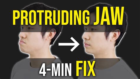 Dec 16, 2020 · can i fix an underbite using braces/invisalign? Protruding Jaw / Underbite Fix ｜Facial Asymmetry ...