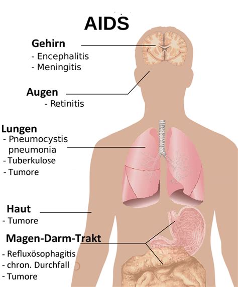 Das virus gehört zur familie der retroviren und zur gattung der lentiviren. AIDS und HIV | Ihre Apotheke informiert