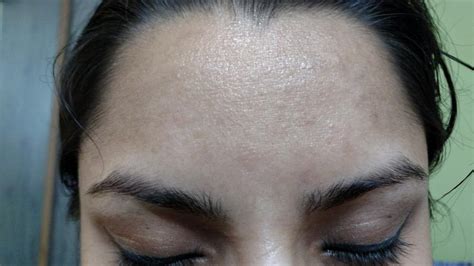 Does micropen help with uneven skin texture. Please help me with what this is, rough forehead skin ...