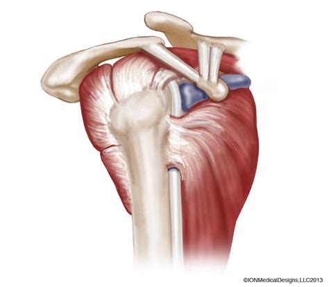 Inflammation in a tendon is known as tendinitis a tendon is a specialized structure that attaches mus. Anatomy of the Shoulder Archives - Joint Preservation Center