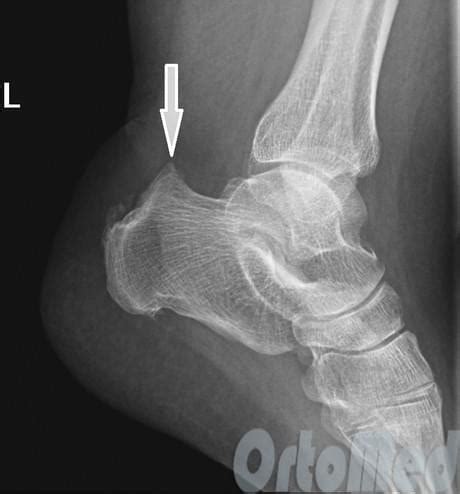 Insertional achilles tendinitis and haglund's deformity. Деформация Хаглунда: причины симптомы лечение | Остеофит ...