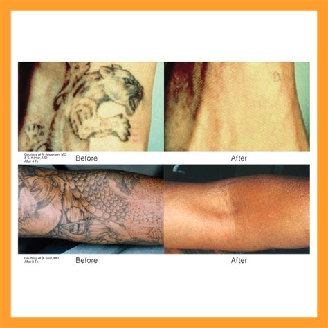 Picosure is faster, more complete, less painful for tattoo removal. Revlite Laser | Melasma, Dark Underarms, Tattoo Removal ...