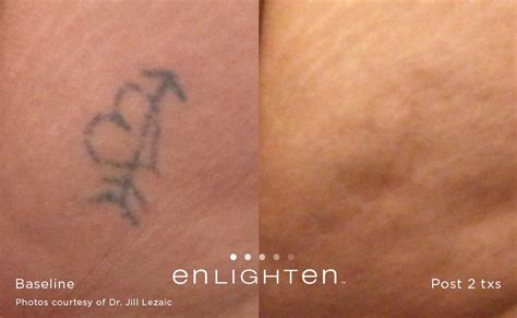 In some cases, the most. Revive At The Group › Tattoo Removal > Laser Tattoo De-Inking