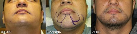 By the following hair transplant results, the hairline clinic wants to present some results with patients. Facial Hair Transplant - Before and After Pictures * | Dr ...