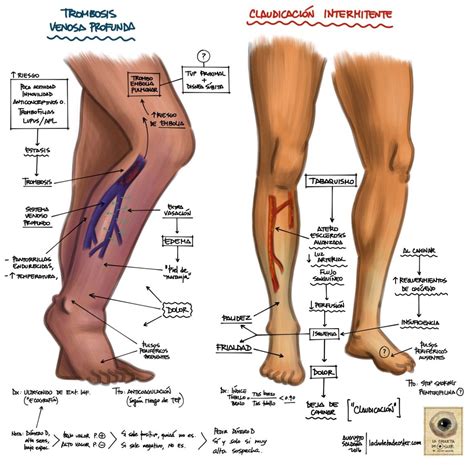 Si bien estos coágulos ocurren más comúnmente en las venas de las piernas (la pantorrilla o el muslo), también pueden desarrollarse en. Pin en Medicine