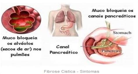 Mãe 30 anos com gravidez normal; Van Helsing Rede social & Pesquisas: O Que e A Fibrose Cistica