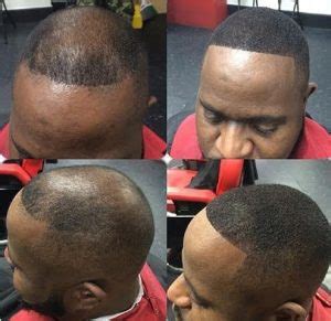 Black men have unique hair grooming needs that aren't served by generic grooming products. The Best Treatments For Male Pattern Baldness. : ThyBlackMan