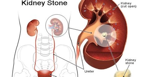 Cholelithiasis atau batu karang dalam pundi hempedu semakin menular dikalangan kita kerana pemakanan yang tidak seimbang. Kesan Ubat Darah Tinggi Kepada Lelaki - Kerja Kosm