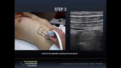 For deeper tissues, a lower frequency (usually from. Ultrasound Podcast - Appendicitis Remix Part 2 - YouTube